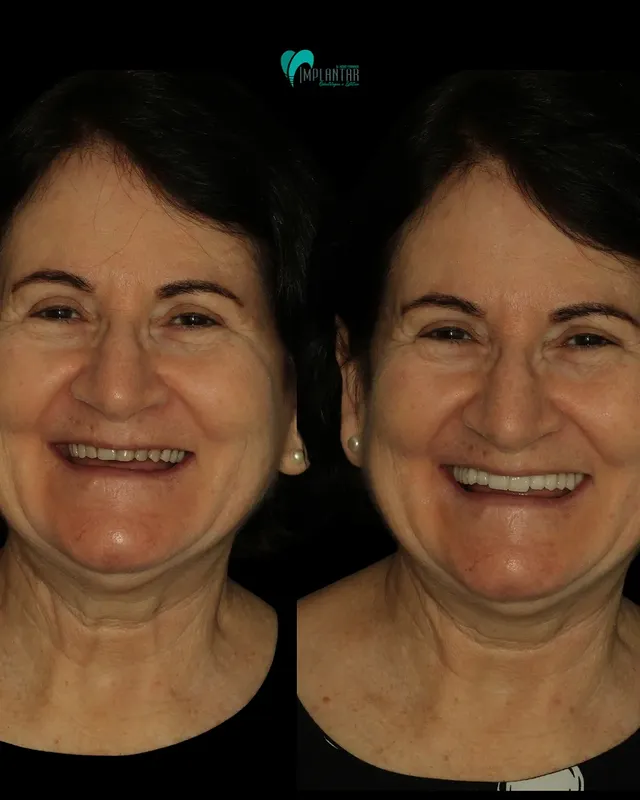 Antes e depois reabilitação oral
