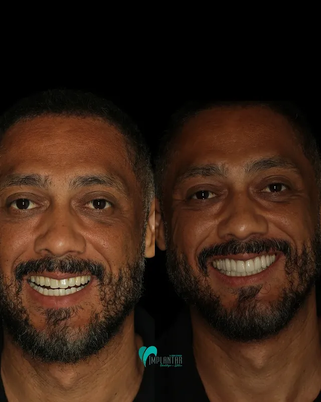 Antes e depois estética do sorriso