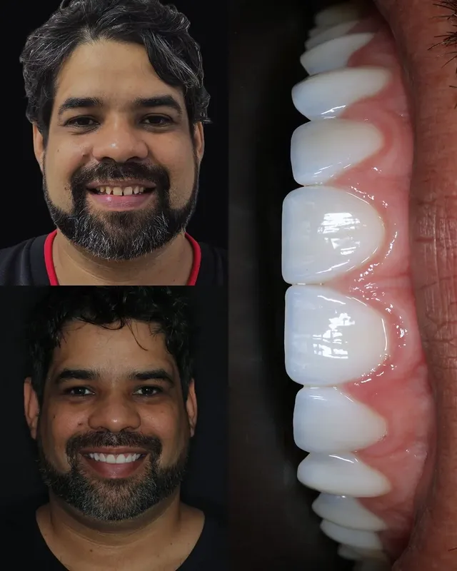 Detalhe de lentes em porcelana
