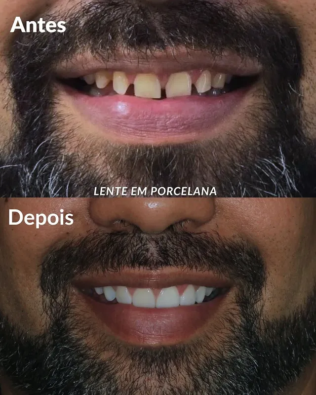 Antes e depois lente em porcelana