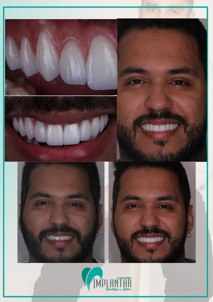 Caso de lentes de contato dental
