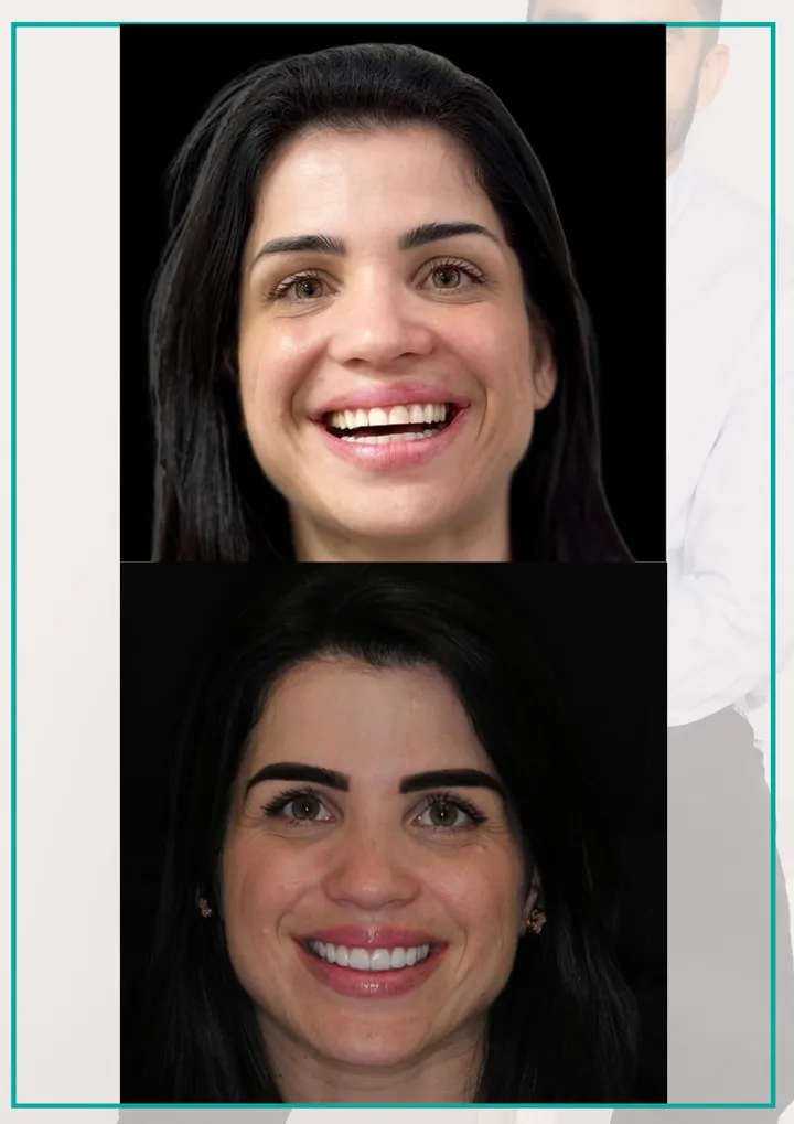Antes e depois de lentes de porcelana