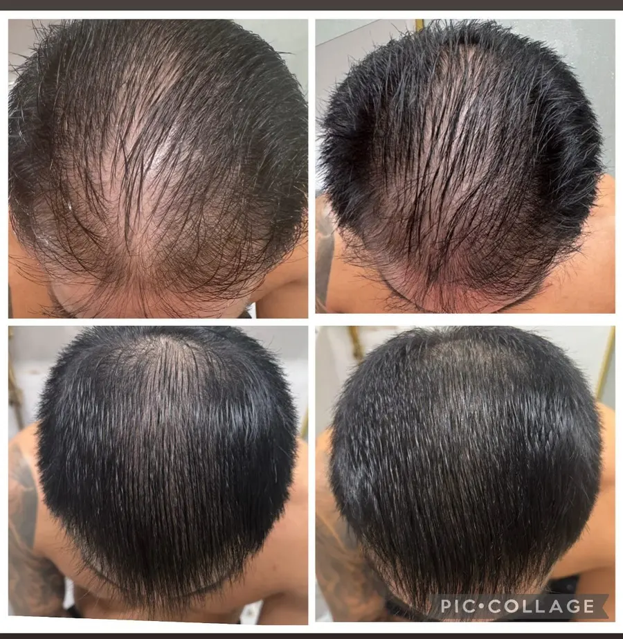Antes e depois de tratamento capilar