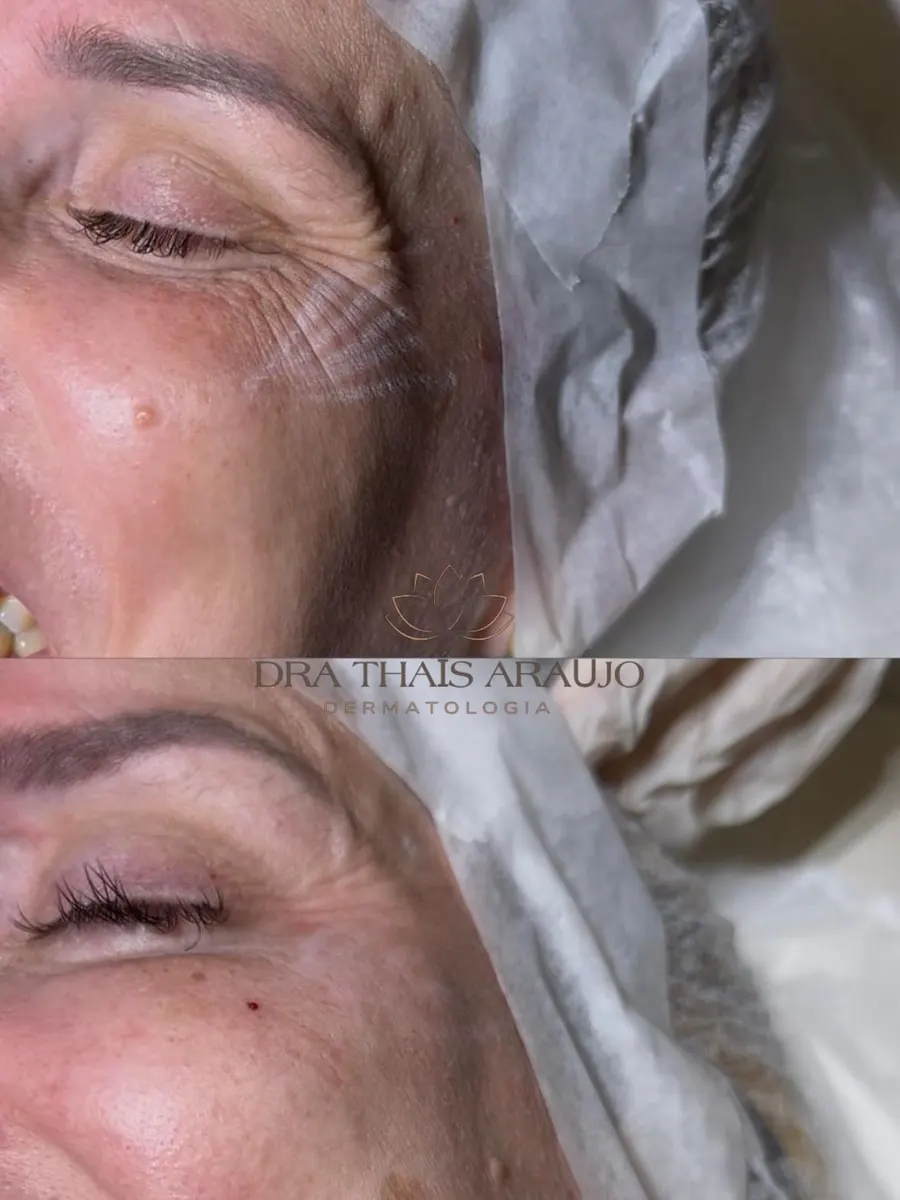 Antes e depois na região dos olhos