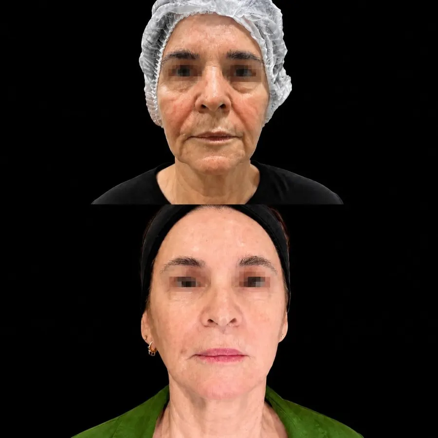 Antes e depois de rejuvenescimento facial