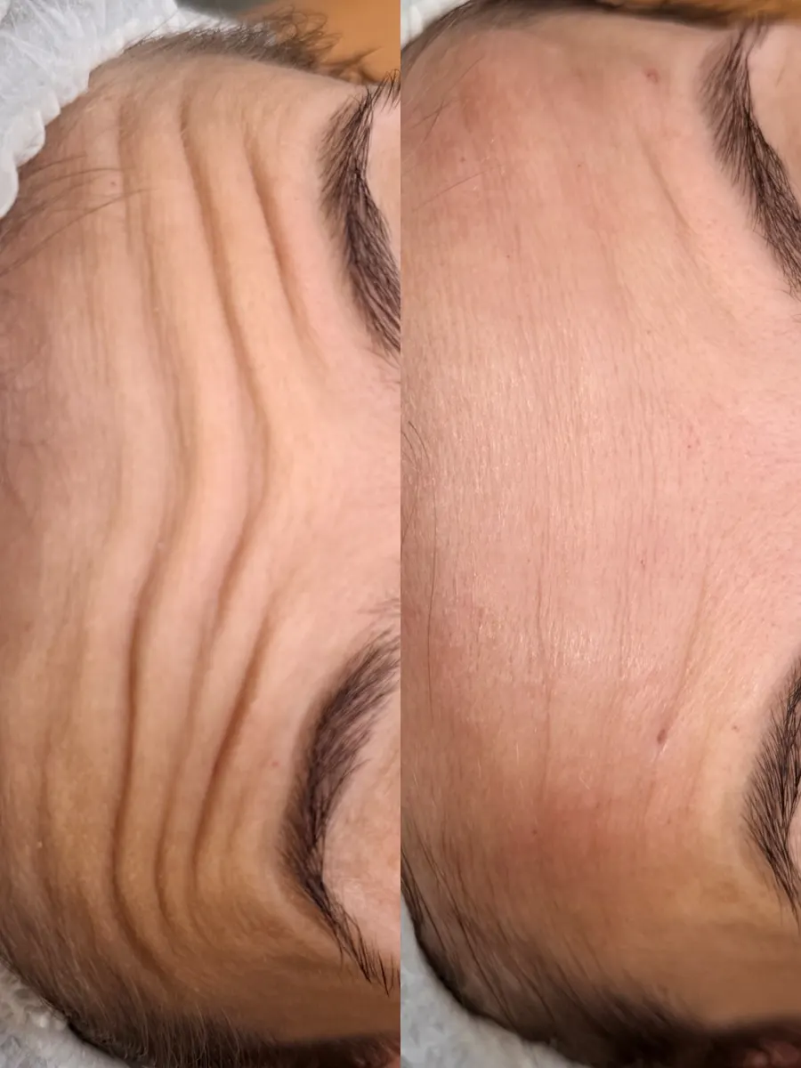Antes e depois de suavização das linhas de expressão