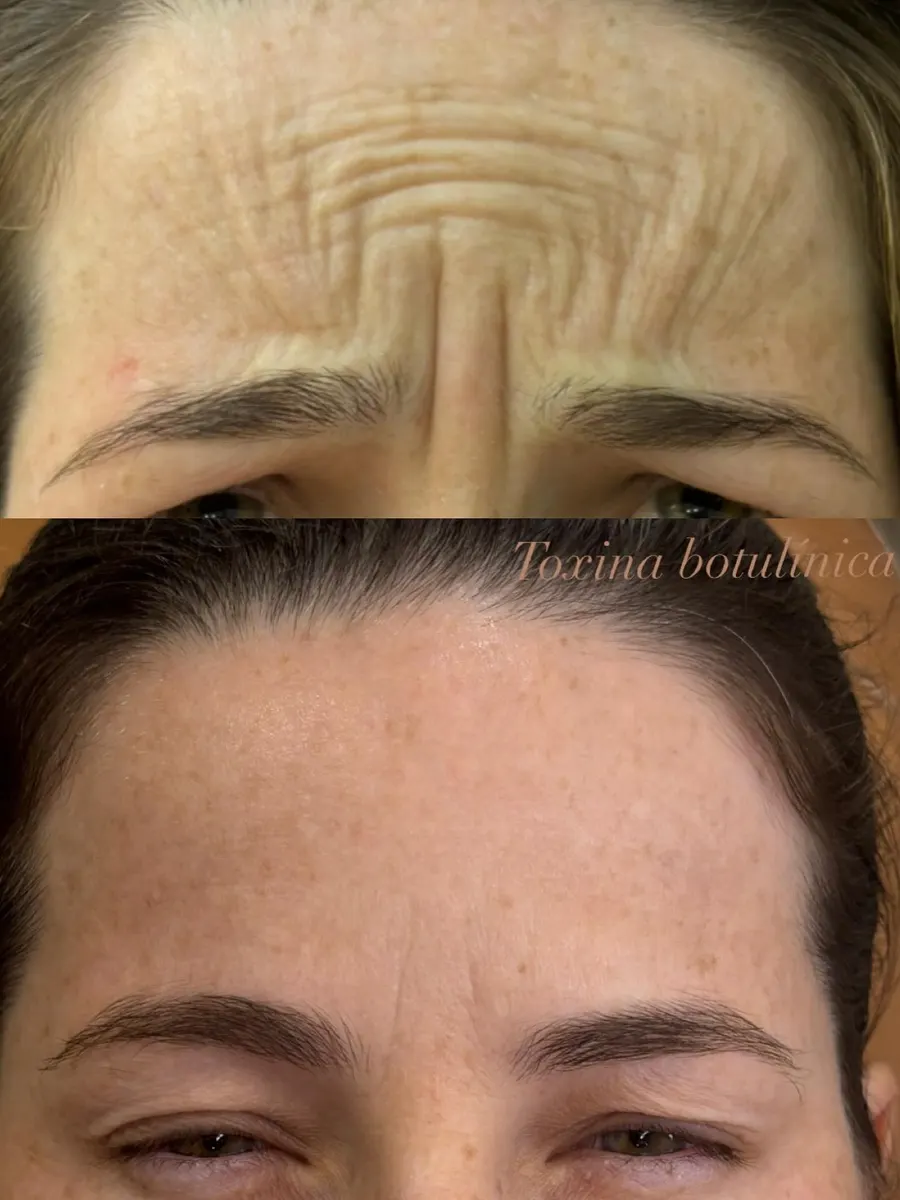 Antes e depois de suavização de rugas na testa